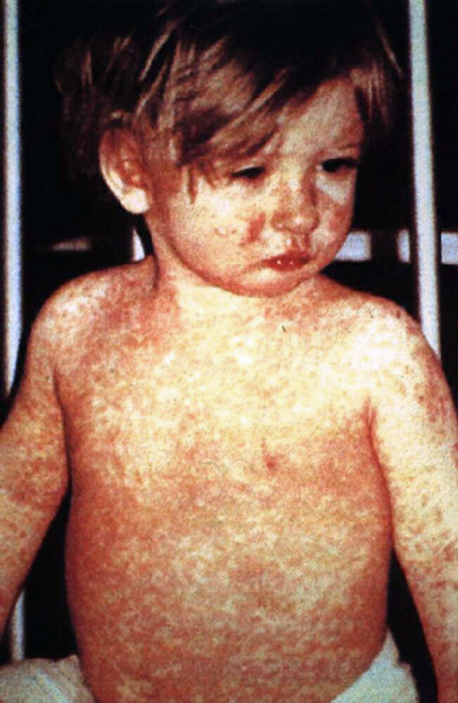 Measles presents as a red, blotchy skin rash. Other symptoms are fevers, sore throat, cough, runny nose and inflamed eyes. The symptoms show up typically 10 to 14 days after exposure. (Credit: Centers for Disease Control.)